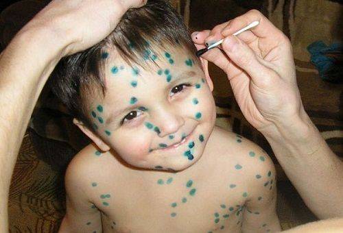 chickenpox in a boy