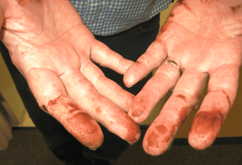 spots of potassium permanganate on the hands