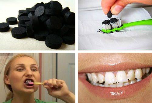 sbiancamento dei denti