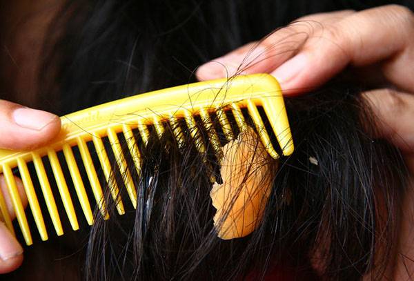 Česanie žuvačky z vlasov
